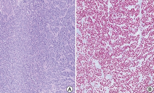 Figure 3. Robotic-assisted laparascopic cystourethrectomy of urinary bladder showing sheets of highly atypical melanoma cells. (A & B) Robotic-assisted laparoscopic radical cystourethrectomy showing sheets of highly atypical dyscohesive melanoma cells in the urinary bladder 10× (left), tumor cells demonstrate positivity for SOX10 (right).