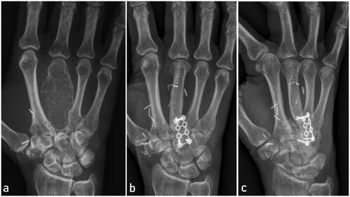 Figure 1. Preoperative x-ray showing the tumor encompassing the entire third right metacarpal including the metacarpal head (a). Follow-up x-rays one year after metacarpal reconstruction with MFC bone flap in dorsopalmar (b) and lateral view (c). Note the preservation of metacarpal length and distal bone remodeling at the metacarpal head.