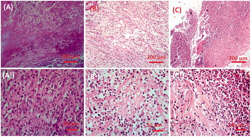 Figure 11. The histopathological examination of control and experimental rat liver; (A, A1) control, (B, B1) diabetic mellitus rats (C, C1) diabetic rats treated with CS–ZnO–RS in different microscopic magnifications (×40 and ×10).