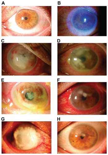 Figure 1 A) and B) Conjunctival keratinization and moderate superficial keratitis punctata. C) Infectious ulcers with total hipopion. D) Infectious ulcers with 2 mm hypopion. E) Perforation with drainage of purulent content. F) Improvement of infectious keratitis. G) Residual leukoma and disappearance of ocular xerophthalmia. H) Coating with amniotic membrane.