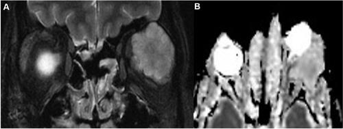 Figure 2 Pleomorphic Adenoma of The Lacrimal Gland; (A) Coronal fat saturated T2-WI and Apparent Diffusion Weight (ADC) image with lobulated outline, (B) Non-restricted pattern on Diffusion Weight Image (DWI).