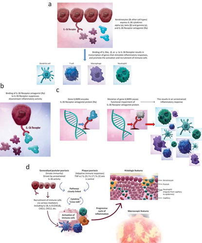 Figure 2. Pathoimmunology of GPP. (a) Role of IL-36 cytokines. (b) Role of IL-36 receptor antagonist. (c) Role of IL36RN gene mutation. (d) Proposed central mediators in GPP [Citation29,Citation31]. (See also online video animation)