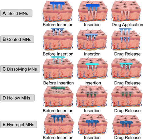 Figure 3 Schematic diagram showing the different types of MNs reported to date. Also shown is the mechanism in which the different MNs are used for transdermal drug delivery. (A) Solid MNs. (B) Coated MNs. (C) Dissolving MNs. (D) Hollow MNs. (E) Hydrogel MNs.