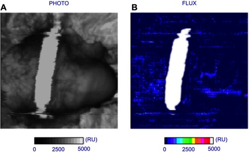 Figure 5 The Dribblestop penile compression device (PCD) had, by 60 mins wear time, decreased distal blood perfusion flux (Figure 4) after an initial rise corresponding to a sustained increase in interfacial pressure (Figure 3). (A) Scanned image (B) PCD location superimposed over flux scan.