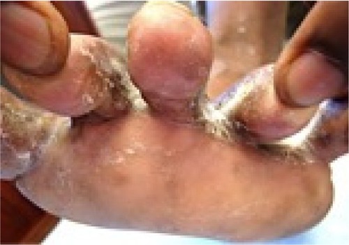 Figure 15 Tinea pedis due to Trichophyton interdigitale.