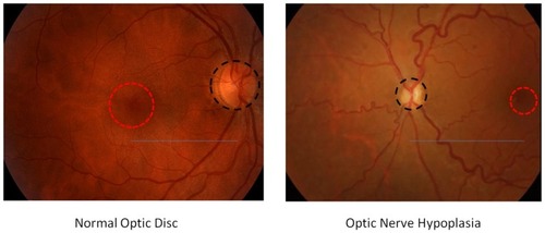 Figure 1 For a proper comparison between normal optic disc and optic nerve hypoplasia (ONH), the examiner should take into account the size of optic disc (disc diameter shown as a dashed black circle) compared to the macula (macula diameter shown as a dashed red circle) as well as the relative disc size (ratio accounting for the distance between optic disc and macula shown as a continuous blue line). As a general rule, ONH is diagnosed when the ratio is < 0.4.