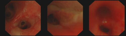Figure 2 Bronchoscopy revealing congestion and edema of the mucosa at the mouth of the left lingual duct.