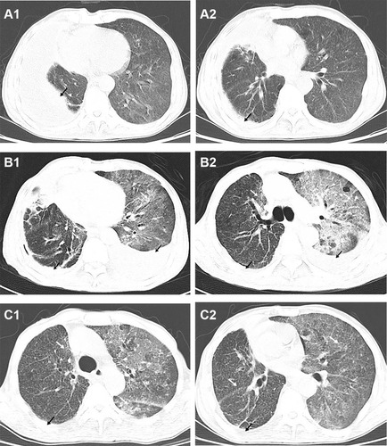 Figure 1 Comparison of cross-sectional chest CT images at different time points. Before admission (Day −2), a large pleural effusion (black arrow) was seen in the right lung on two cross sections (A1 and A2); When the patient’s condition worsened (Day 10), new pleural effusion (black arrow) in the left lung and diffuse patchy shadow (white arrow) in both lungs were shown in two cross sections (B1 and B2); Before discharge (Day 15), two cross-sections of chest CT (C1 and C2) showed absorption of left pleural effusion, reduction of right pleural effusion (black arrow), and reduction of diffuse patchy shadow in both lungs (white arrow).