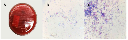 Figure 3 Routine bacterial culture result, identification of bronchoscopy specimens: Nocardia (Magnifications: 100×). (A) yellowish bacterial colony growing after bronchoscopy specimen inoculated on the culture medium. (B and C) Gram-positive, partial acid-fast positive, rod-shaped bacterium.