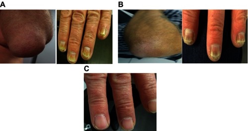 Figure 4 Case 3: psoriasis on the left elbow and nails (A) before and (B) after 16 weeks on brodalumab, and on the nails (C) after 32 weeks on brodalumab.