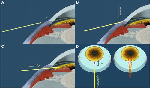 Figure 1 Overview of the main steps of the new surgical technique. (A) The needle is aimed to pierce the sclera starting 3 mm from the limbus. (B) Once the needle has reached the limbus it is pushed downwards. (C) The needle goes into the anterior chamber. (D) Once the tunnel is created with the triangular blade, the path of the needle used to enter the anterior chamber may be not perfectly coaxial with the tunnel, thus creating a false passage.