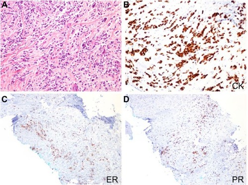 Figure 2 (A) Photomicrographs of tissue specimens from left breast mass stained with hematoxylin and eosin at medium magnification demonstrates discohesive neoplastic cells in a single-file infiltrating pattern with little or no evidence of cellular and nuclear pleomorphism. Immunohistochemical stained slides at medium magnification shows (B) positive expression of lesional cells to cytokeratin (CK) antibodies with (C) coexpression of estrogen receptor (ER) and (D) progesterone receptor (PR) antibodies.