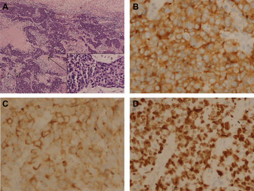 Figure 2 Immunohistochemical staining. (A) Hematoxylin-eosin staining of the tumor tissue (40X and 400X); (B) Immunohistochemical staining for Synaptophysin (Positive, 400X); (C) Immunohistochemical staining for Chromogranin A (Positive, 400X); (D) Immunohistochemical staining for Ki-67 (80% Positive, 400X).
