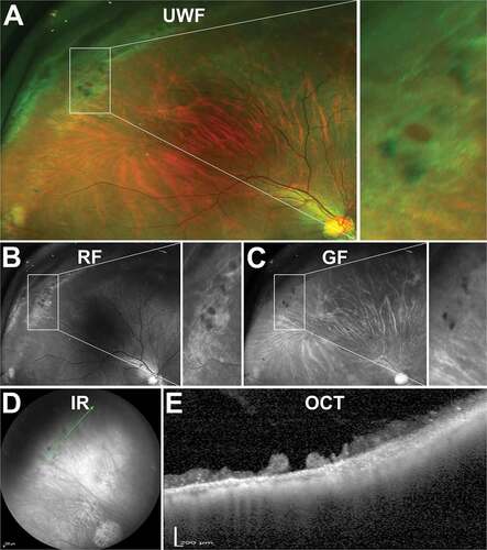 Figure 15. 23 year old Caucasian female with atrophic retinal hole within an area of lattice degeneration. (A) UWF imaging, (B) red and (C) green-free and (D) infra-red imaging show similar characteristics to operculated holes of a round lesion with a surrounding cuff. (E) Peripheral OCT highlights the full-thickness loss of retinal tissue at the site of the hole but no sign of overlying or displaced tissue. Abbreviations as in Figure 3.
