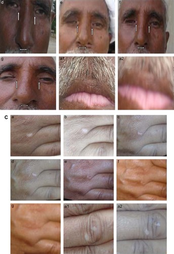 Figure 6 (A–C) Evolution of pigmentation.