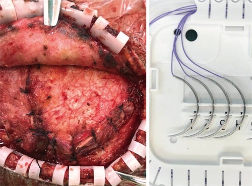Figure 1 Vicryl Plus suture used in craniotomy surgery.