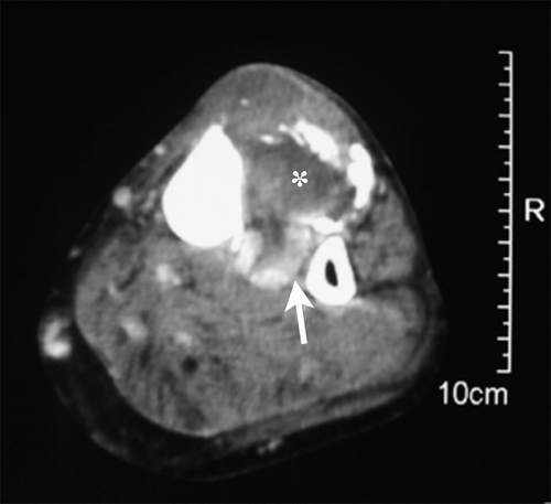 Figure 3.  Postcontrast CT showed a 4×6 cm sized mass with central low signal density (asterisk) and peripheral high density, suggesting fluid and peripheral calcification. The space between the tibia and fibula was also enhanced (arrow).