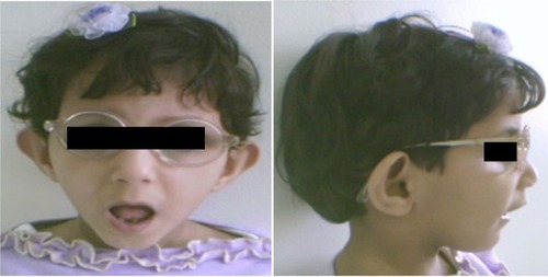Figure 1 Facial features of a 12-year-old girl with Sanjad–Sakati syndrome.