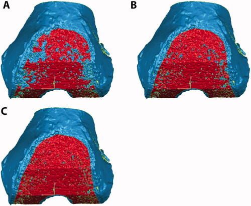 Figure 2. Femoral cut surfaces were selected (red) based on crease angles of 15° (A), 20° (B), and 25° (C). As the crease angle is increased, more porous regions are selected.