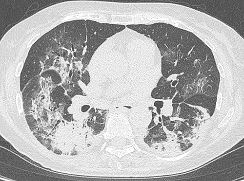 Figure 1 Computed tomography (CT) scan of the chest on admission. The CT scan showed frosted glass shadows and partial dense infiltration in bilateral lungs.