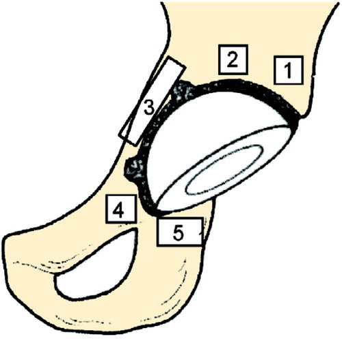 Classification of periprosthetic BMD in 5 ROIs.