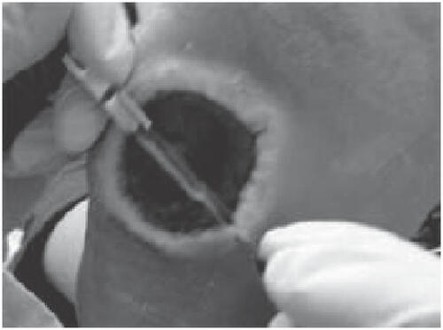 Figure 5 Debridement of wound margins to mitigate the “edge effect”.