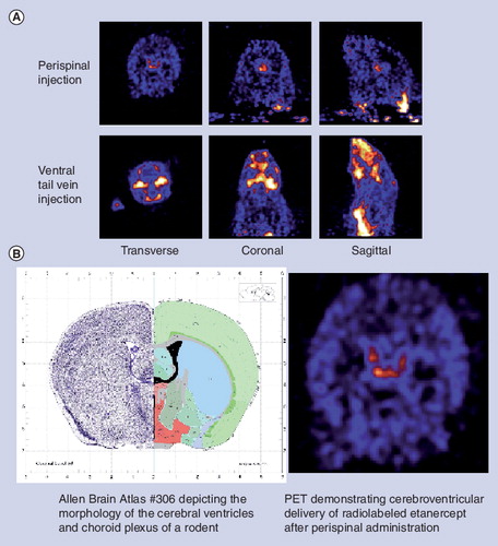 Figure 3. PET images of a living rat brain following peripheral administration of 64Cu-DOTA-etanercept.The distinctive central pattern of brain distribution suggests penetration of 64Cu-DOTA-etanercept into the CSF in the lateral and third ventricles and accumulation of tracer within the choroid plexus following perispinal administration. (A) The pattern following perispinal administration is distinct from that following ventral tail vein injection. (B) Comparison of the transverse PET image following perispinal injection with section 306 from the Allen Brain atlas Citation[201].CSF: Cerebrospinal fluid; DOTA: 1,4,7,10-tetraazadodecane-N,NI,NII,NIII-tetraacetic acid.