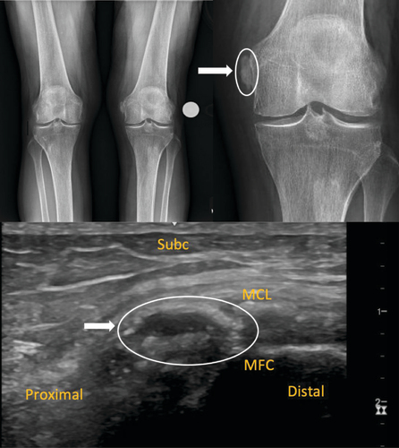 Figure 1. Standing weight bearing anterior to posterior (AP) radiographs of the knee.Initial evaluation where a 2.4 mm calcification is noted at the left femoral medial condyle (white arrow), also showed lateral compartment chondrocalcinosis and mild osteoarthritis (upper panel). Initial diagnostic musculoskeletal ultrasound imaging of the medial knee in a longitudinal view showing a lobulated calcium at the medial femoral condyle within the proximal medial collateral ligament. White arrow indicated the calcification of the MCL (lower panel).Subc: Subcutaneous tissue; MCL: Medial collateral ligament; MFC: Medial femoral condyle.