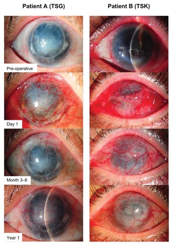 Figure 2 Pre- and postoperative recovery (up to 1 year) of two patients after Gundersen flap surgery with fibrin glue.