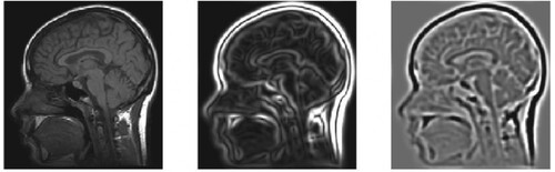 Figure 2. An example of Hessian matrix applied on MRI image.