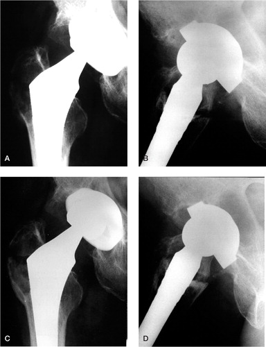 Figure 2. A 56-year-old man who had THA on the left side 6 years previously presented with gradual onset of lateral hip pain lasting for 2 months without any trauma. The anterior/posterior (A) and the lateral (B) radiographs showed a non-displaced fracture through an osteolytic cyst of the greater trochanter. The prosthesis was well-fixed. 2 years later, the anterior/posterior (C) and the lateral (D) radiographs showed that the fracture had healed. The femoral head was more eccentric, demonstrating polyethylene wear.