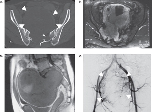 Figure 1. Case 2. CT (A) showing bony destruction of the sacrum and tumor outline (white arrow-head). Axial image (B) and sagittal image (C) of MRI showing the enormous tumor with heterogeneous signal intensity. Preoperative angiogram (D) showing a high vascularity of the tumor (white arrow-head) from both internal iliac arteries. The tumor was excised completely by a piecemeal excision with right S1 root sacrifice via the posterior and anterior approach.