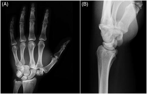 Figure 1. Pre-reduction AP and lateral radiograph of the left wrist.