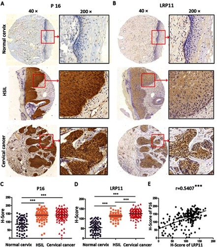 Figure 2 Expression of LRP11 and P16 in cervical cancer tissues and their correlation. (A and B) The expression of P16 and LRP11 in normal cervix, high squamous intraepithelial lesion (HSIL) and cervical cancer tissues (×40 and ×200). (C and D) The H-Score of P16 and LRP11 in normal cervix, HSIL and cervical cancer. (E) The correlations between expression of P16 and LRP11. ***P<0.001.