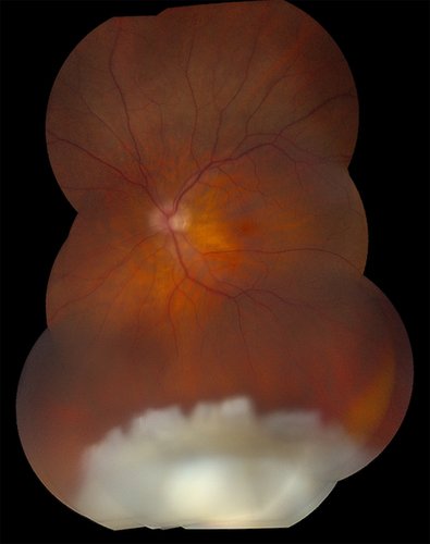 Figure 1 Fundus photo demonstrating posteriorly dislocated retained lens fragments after cataract surgery.