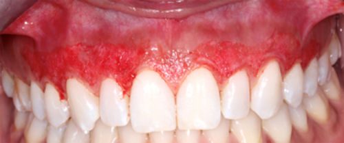 Figure 3 Picture of the full upper arch after gingival depigmentation.