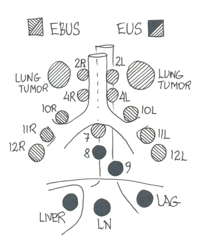 Figure 2. Overview of structures that can be reached by EBUS, EUS/EUS-B or both.