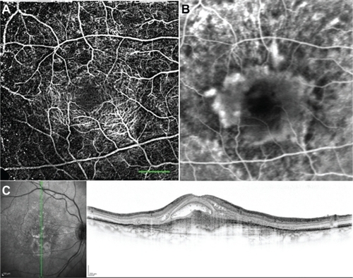Figure 8 nCPM imaging of an AMD patient. (A) nCPM image (eight series combined into one) from a 73-year-old female suffering from AMD with a neovascular membrane in the right eye. White dots appear as a result of drusen. (B) Corresponding FA image. (C) Corresponding OCT images demonstrating mostly scarred neovascularization combined with some retinal fluid.