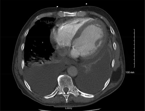 Figure 3. CT chest showing bilateral pleural effusions and moderate pericardial effusion with dilated cardiomyopathy.
