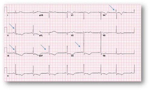 Figure 4. Sinus bradycardia at ventricular rate of 46 bpm, prolonged QT (658 msec) and QTc (575 msec) with ST depression in the inferior leads. T wave inversion in the anterior leads (V3–V4) and inferior leads (II, III, aVf) ‘arrows’.