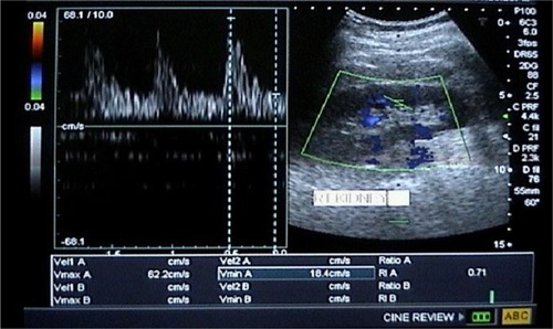 Figure 3 Doppler sonography of the right kidney showing increased renal arteriolar resistive index with a value of 0.71.