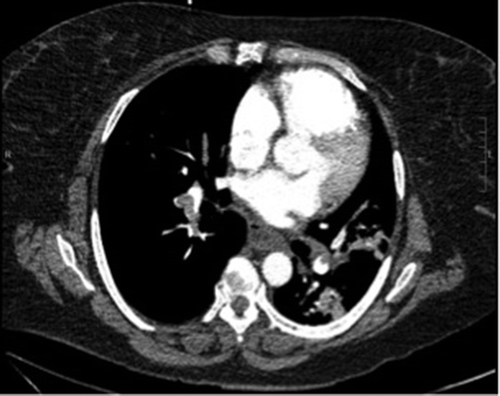 Figure 2. CT angiography. Large burden of pulmonary emboli in all segmental and sub-segmental branches of all 5 lobes with significant right heart enlargement.