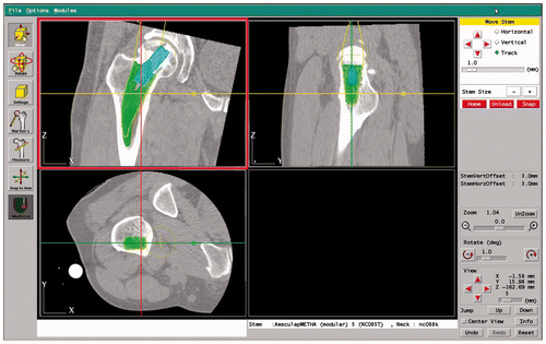 Figure 1. Preoperative planning was performed using the ORTHODOC workstation.