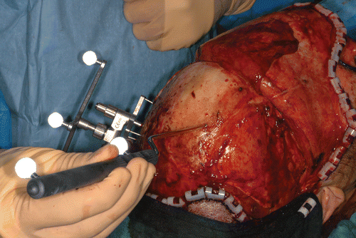 Figure 7. Patient registration. Intra-operative use of a blunt-tip pointer with two reflective marker spheres to indicate the screw heads to the navigation system.