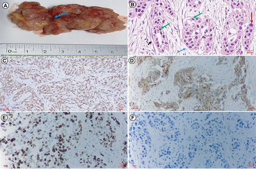 Figure 1. Macroscopic, histopathological and immunohistochemical characteristics of primary tumor of the ovarian cancer patient.Histopathology and immunohistochemistry of ovarian cancer. (A) This is a section of the tumor that shows solid areas ranging from tan to white, with minimal necrosis and hemorrhage (blue arrow). The central part of the tumor was taken for histopathology. (B) Glandular and cribriform patterns (black and blue arrow). The tumor consists of columnar to cuboidal cells with eosinophilic cytoplasm. Prominent nucleolus (red arrow), often large and eosinophilic has to be seen. A high mitotic index is ≥12 mitotic figures per 10 high power fields, which is often atypical (green arrow). (C) Malignant cells show nuclear staining with WT1; (D) Malignant cells show strong and diffuse membranous staining with CA125; (E) Malignant cells show strong and diffuse nuclear staining with Ki67(red arrow), accounted 70%; (F) Malignant cells show a complete absence of staining with p53, corresponding to loss of function mutation that results in a truncated protein that is not detected.