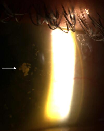 Figure 3 Midday fogging with large, white floating debris. This image captures the presence of a large globule of debris surrounded by smaller globules within the post lens tear reservoir. The arrow indicates a large, coalesced collection of this debris. Initially debris with this appearance was hypothesized to be mucin. No laboratory tests have not yet confirmed the presence of mucin in midday fogging.