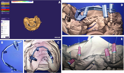 Figure 3 (A) Virtual surgical and prosthetic planning using exocad. (B) Isolated planned fixture. (C) Planned fixture superimposed on underlying tissue. (D) Horizontal view of planned fixture. (E) Abutments.