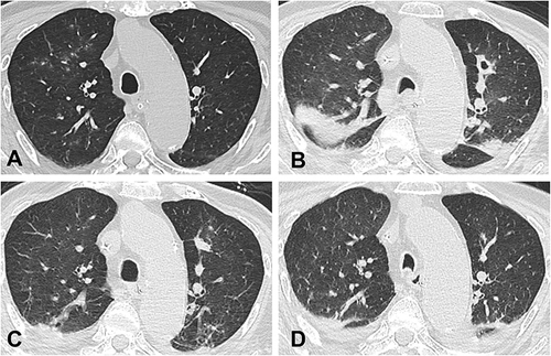 Figure 1 The patient’s CT scan of the chest during treatment. Chest CT at admission showed new patchy ground glass opacities in the right upper lung and right middle lobe (A). On day 36 after admission, the patient’s condition deteriorated with new bilateral patchy infiltrates and a notable lung cavity (7 mm × 8 mm) in the anterior segment of the left upper lobe, though the primary ground glass opacity lesions in the right lung were resolved (B). The lung cavity lesion disappeared following 13 days of linezolid and 10 days of contezolid (C). After a nearly 4-month course of contezolid therapy, follow-up CT revealed that the lung cavity lesion and patchy infiltrations on both sides of the lung had disappeared entirely (D).