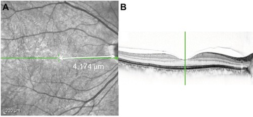 Figure 1 Infrared image (A) and SD-OCT image (B) of a 66-year-old woman before the opening of an MH.