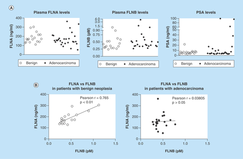 Figure 4.  Detection of filamin-A and -B in human plasma.ELISA was used to detect FLNA and FLNB levels in blood samples from patients with suspected prostate cancer. (A) Scatterplot representation of FLNA, FLNB and PSA levels in patients. (B) Correlation analysis of FLNA and FLNB in patients with benign cases or adenocarcinoma. FLNA: Filamin-A; FLNB: Filamin-B; PSA: Prostate-specific antigen.